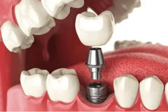种牙第二步安装基台会痛吗？局部麻醉有作用没？