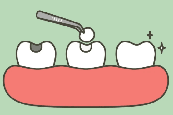 月经来可以补牙洞吗 月经期间能补牙齿吗