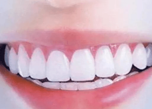 牙齿蛀牙烂太深了痛怎么办 智齿根管治疗需要多少钱