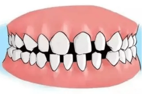 牙龈萎缩了还能种牙吗？主要看牙周是否有疾病或者有炎症存在