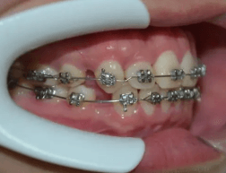 牙齿矫正可以二次矫正吗？牙齿矫正一般是可以做第2次矫正的