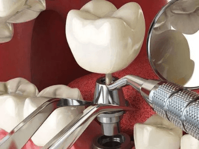 大庆有哪些种植牙技术不错的专家？最新五大种植牙医生排名公布